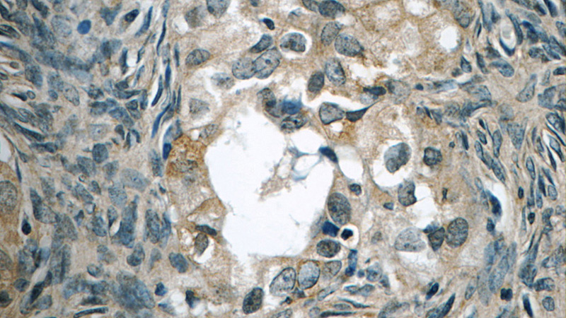 Immunohistochemistry of paraffin-embedded human ovary tumor tissue slide using Catalog No:116832(WIT1 Antibody) at dilution of 1:50 (under 40x lens)