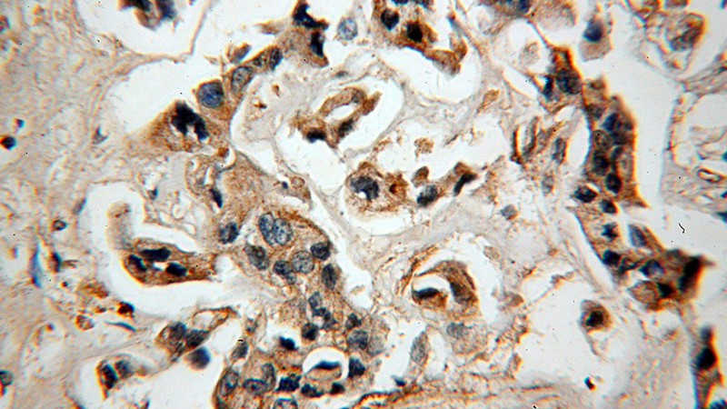 Immunohistochemical of paraffin-embedded human breast cancer using Catalog No:112263(LACRT antibody) at dilution of 1:50 (under 40x lens)