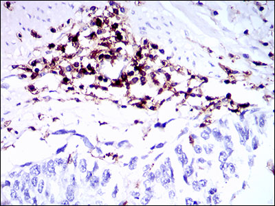 Immunohistochemical analysis of paraffin-embedded esophageal cancer tissues using PTPRC mouse mAb with DAB staining.