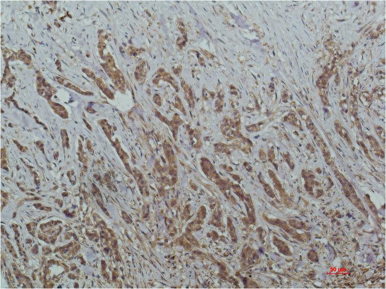 Immunohistochemical analysis of paraffin-embedded Human Breast Carcinoma Tissue usingHADC1 Mouse mAb diluted at 1:200.