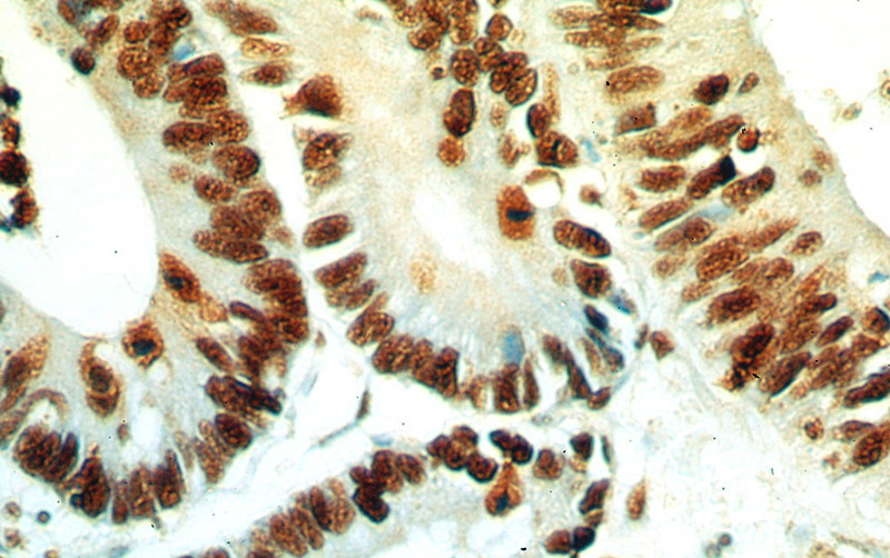 Immunohistochemical of paraffin-embedded human colon cancer using Catalog No:117084(NPM1 antibody) at dilution of 1:100 (under 40x lens)