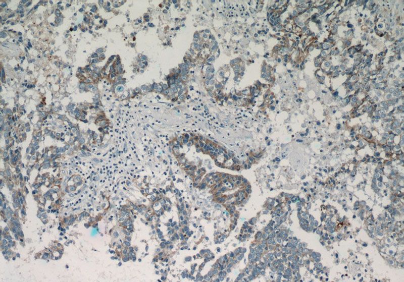 Immunohistochemistry of paraffin-embedded human breast cancer tissue slide using Catalog No:112645(MAP2K4 Antibody) at dilution of 1:50 (under 10x lens)