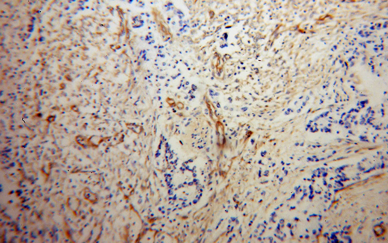 Immunohistochemical of paraffin-embedded human colon cancer using Catalog No:112941(MYL12B antibody) at dilution of 1:100 (under 10x lens)