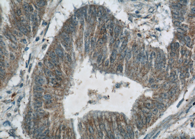 Immunohistochemistry of paraffin-embedded human colon cancer tissue slide using Catalog No:111889(JMY Antibody) at dilution of 1:50 (under 40x lens)