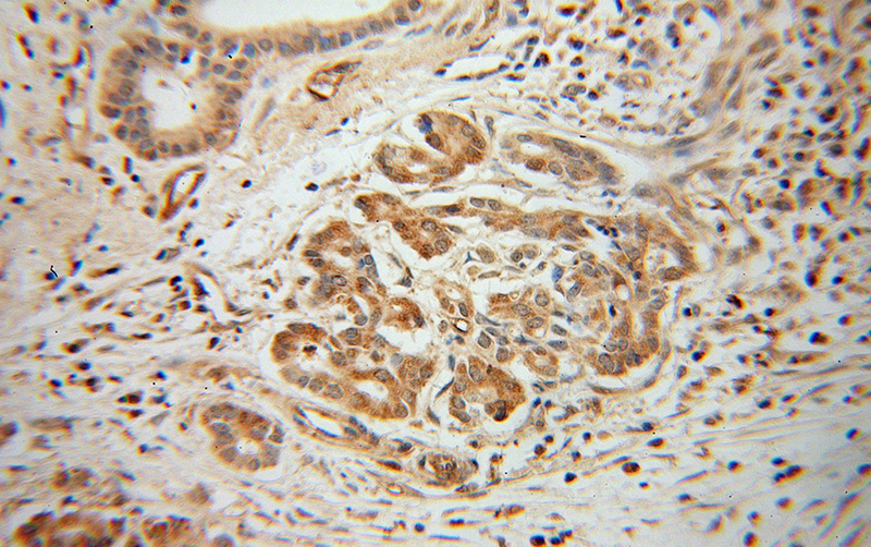 Immunohistochemical of paraffin-embedded human pancreas cancer using Catalog No:108181(ARHGDIG antibody) at dilution of 1:100 (under 40x lens)