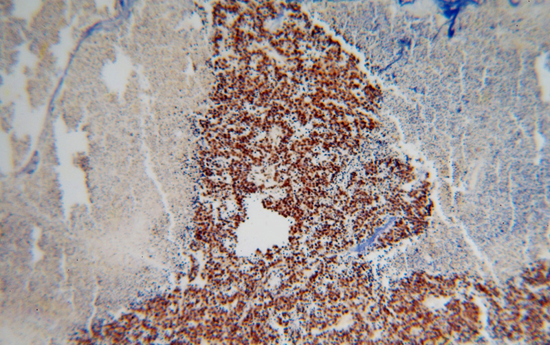 Immunohistochemical of paraffin-embedded human lung cancer using Catalog No:115926(TARDBP antibody) at dilution of 1:100 (under 10x lens)
