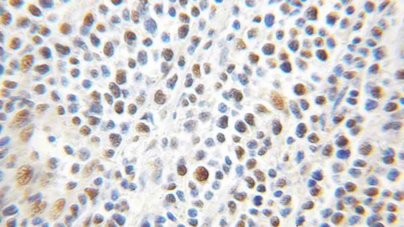 Immunohistochemical of paraffin-embedded human lymphoma using Catalog No:114205(PRMT1 antibody) at dilution of 1:100 (under 10x lens)