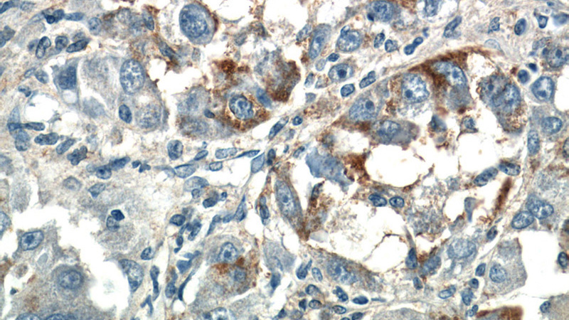 Immunohistochemistry of paraffin-embedded human liver cancer tissue slide using Catalog No:109521(CPPED1 Antibody) at dilution of 1:50 (under 40x lens)