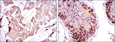 Immunohistochemical analysis of paraffin-embedded breast cancer tissues (left) and testis tissues (right) using SMN1 mouse mAb with DAB staining.