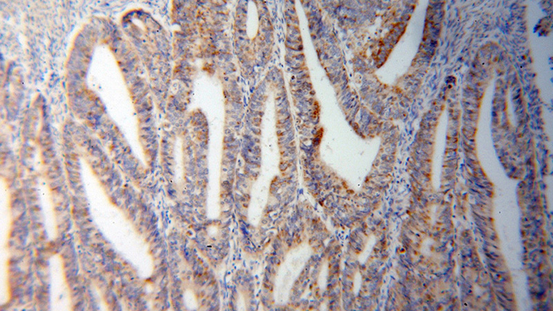 Immunohistochemical of paraffin-embedded human endometrial cancer using Catalog No:116115(TYMS antibody) at dilution of 1:100 (under 10x lens)