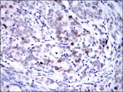 Immunohistochemical analysis of paraffin-embedded cervical cancer tissues using KID mouse mAb with DAB staining.