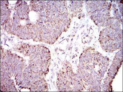 Immunohistochemical analysis of paraffin-embedded rectum cancer tissues using ALDH2 mouse mAb with DAB staining.
