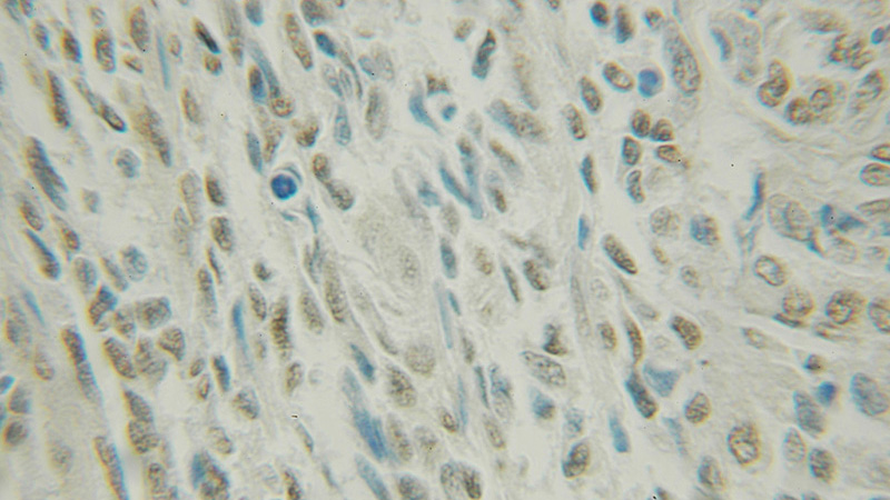 Immunohistochemical of paraffin-embedded human ovary tumor using Catalog No:113366(NUFIP1 antibody) at dilution of 1:50 (under 10x lens)