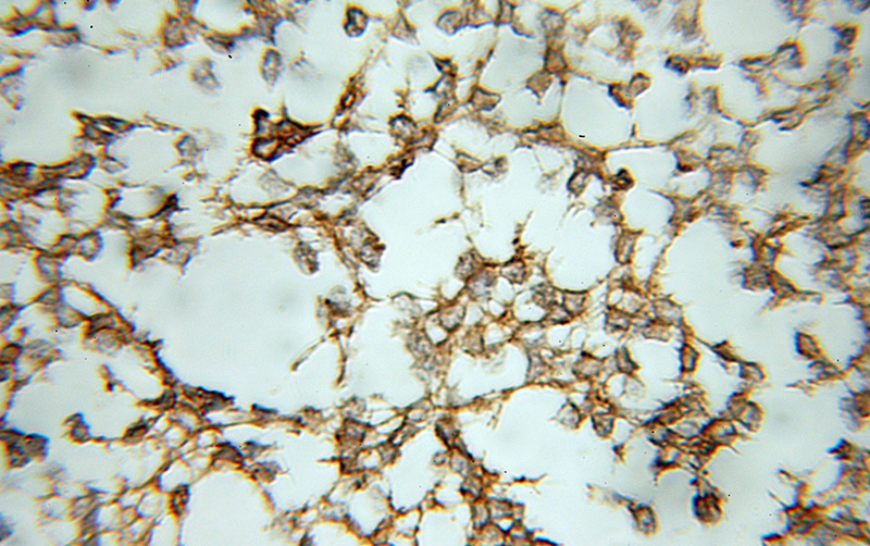 Immunohistochemical of paraffin-embedded human gliomas using Catalog No:114548(RAP1GDS1 antibody) at dilution of 1:50 (under 10x lens)