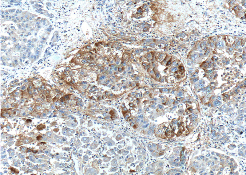 Immunohistochemistry of paraffin-embedded human liver cancer tissue slide using Catalog No:117116(BEND3 Antibody) at dilution of 1:200 (under 10x lens).