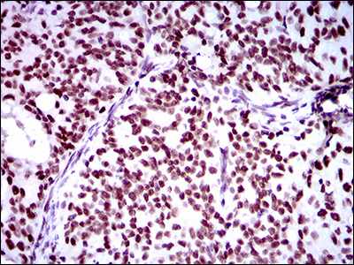 Immunohistochemical analysis of paraffin-embedded cervical cancer tissues using Ring1 mouse mAb with DAB staining.