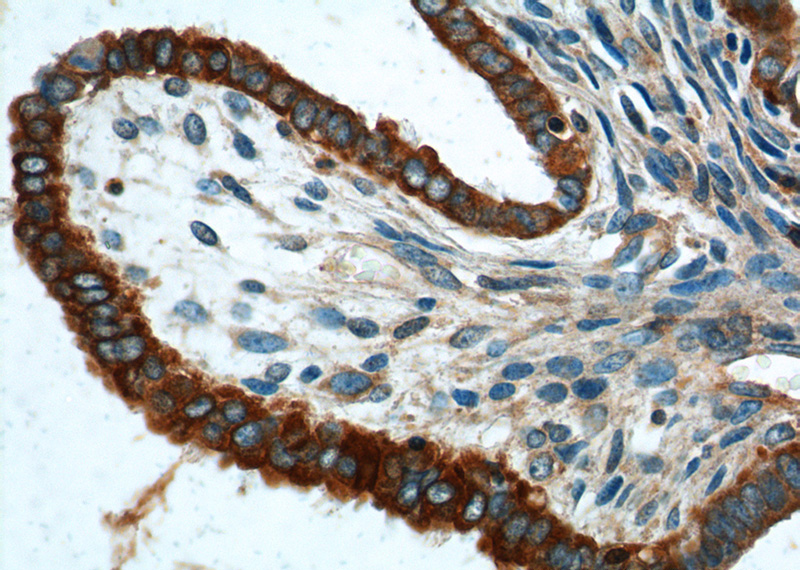 Immunohistochemistry of paraffin-embedded human ovary tumor tissue slide using Catalog No:109810(CK7 Antibody) at dilution of 1:200 (under 40x lens).
