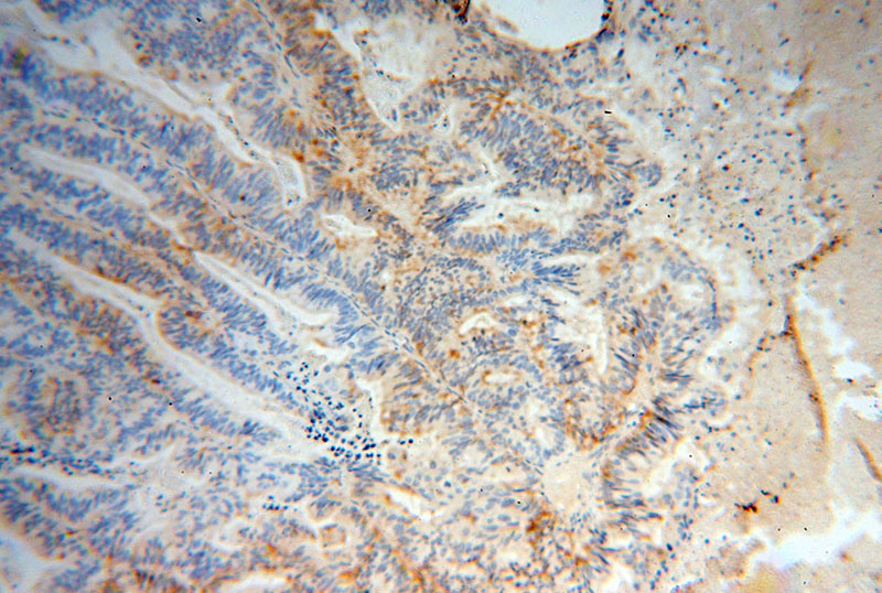 Immunohistochemical of paraffin-embedded human ovary tumor using Catalog No:110742(FST antibody) at dilution of 1:100 (under 10x lens)