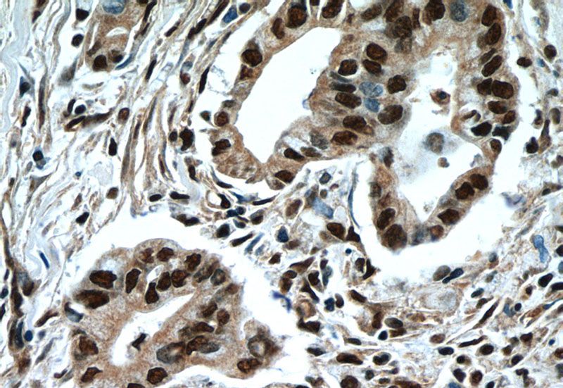 Immunohistochemistry of paraffin-embedded human pancreas cancer tissue slide using Catalog No:113157(NFKB2 Antibody) at dilution of 1:50 (under 40x lens)
