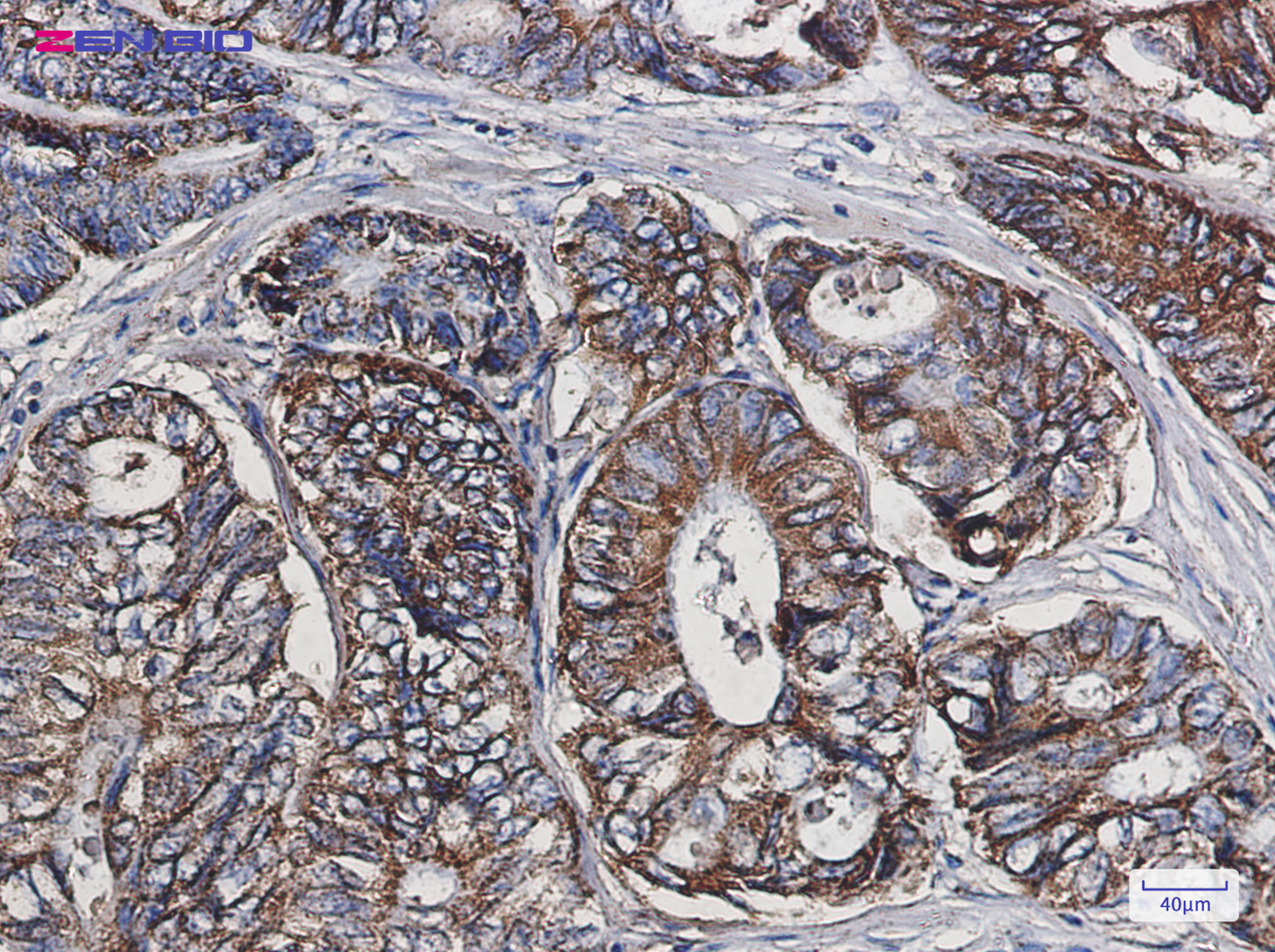 Immunohistochemistry of Cpn10 in paraffin-embedded Human colon cancer tissue using Cpn10 Rabbit pAb at dilution 1/50