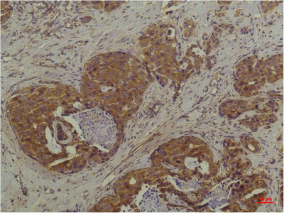 Immunohistochemical analysis of paraffin-embedded Human Breast Carcinoma using P44/42 MAPK (ERK1/2) Mouse mAb diluted at 1:200.