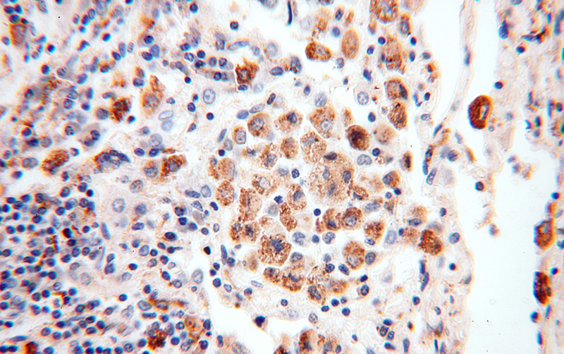 Immunohistochemical of paraffin-embedded human lung cancer using Catalog No:114287(PSAP antibody) at dilution of 1:200 (under 40x lens)