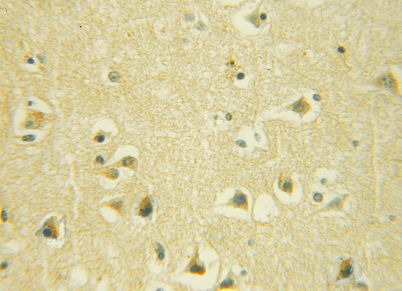 Immunohistochemical of paraffin-embedded human gliomas using Catalog No:110834(GALC antibody) at dilution of 1:50 (under 10x lens)