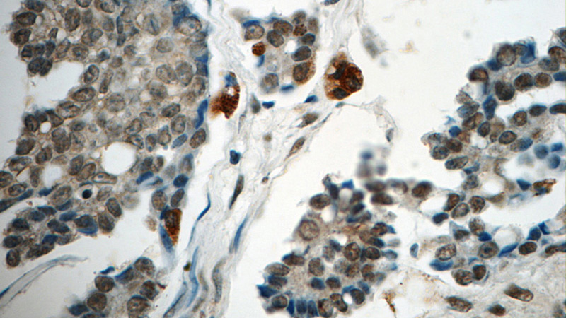 Immunohistochemistry of paraffin-embedded human ovary tumor tissue slide using Catalog No:113464(OBFC2B Antibody) at dilution of 1:50 (under 40x lens)