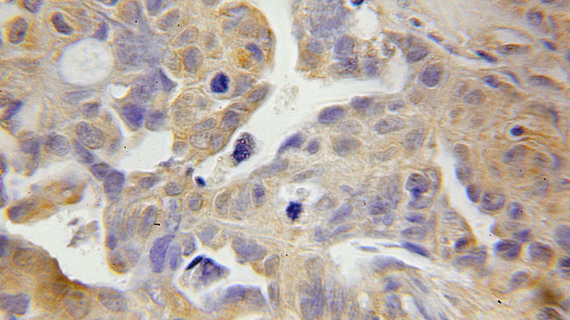 Immunohistochemical of paraffin-embedded human ovary tumor using Catalog No:116439(TSP50 antibody) at dilution of 1:50 (under 10x lens)