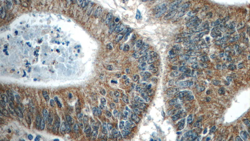 Immunohistochemistry of paraffin-embedded human colon cancer tissue slide using Catalog No:108795(C8orf77 Antibody) at dilution of 1:50 (under 40x lens)