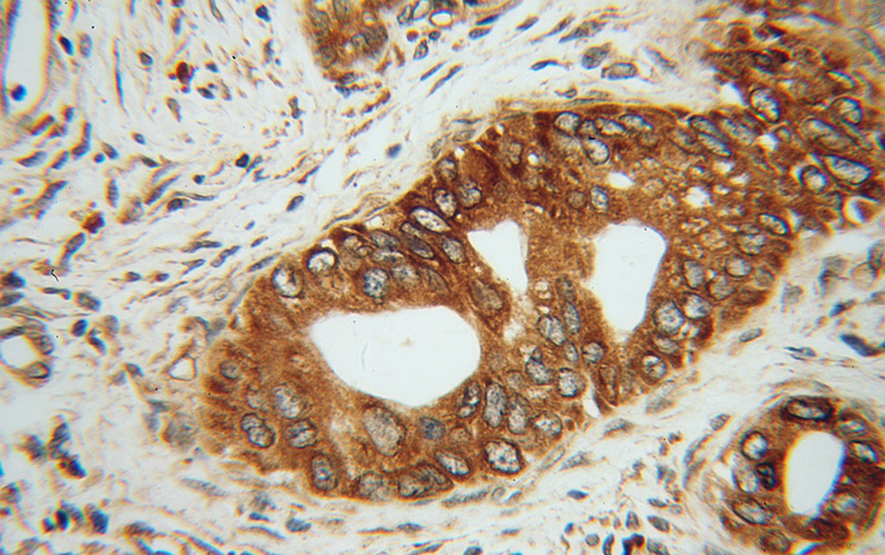 Immunohistochemical of paraffin-embedded human pancreas cancer using Catalog No:109356(CNPY2,MSAP antibody) at dilution of 1:50 (under 40x lens)