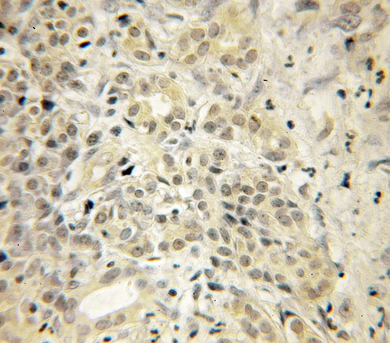Immunohistochemical of paraffin-embedded human pancreas cancer using Catalog No:116672(UCHL3 antibody) at dilution of 1:50 (under 10x lens)