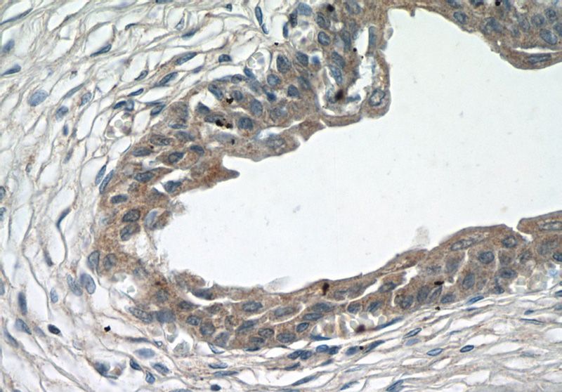 Immunohistochemistry of paraffin-embedded human bladder tissue slide using Catalog No:117040(ZFP36 Antibody) at dilution of 1:50 (under 40x lens)