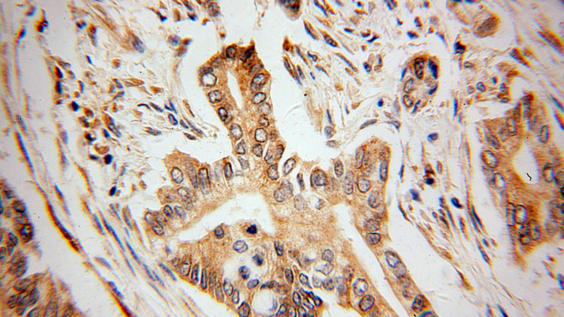 Immunohistochemical of paraffin-embedded human pancreas cancer using Catalog No:116715(VAPB antibody) at dilution of 1:100 (under 40x lens)