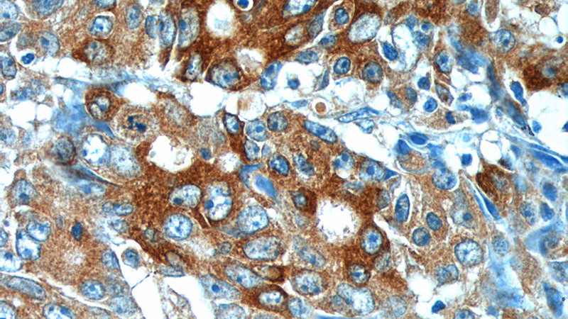 Immunohistochemistry of paraffin-embedded human colon cancer tissue slide using Catalog No:111762(IL17A Antibody) at dilution of 1:200 (under 40x lens).