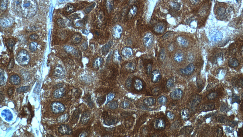 Immunohistochemistry of paraffin-embedded human lung cancer tissue slide using Catalog No:115602(SRX1 Antibody) at dilution of 1:50 (under 40x lens)