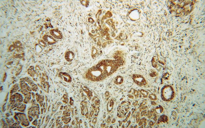 Immunohistochemical of paraffin-embedded human pancreas cancer using Catalog No:109356(CNPY2,MSAP antibody) at dilution of 1:50 (under 10x lens)