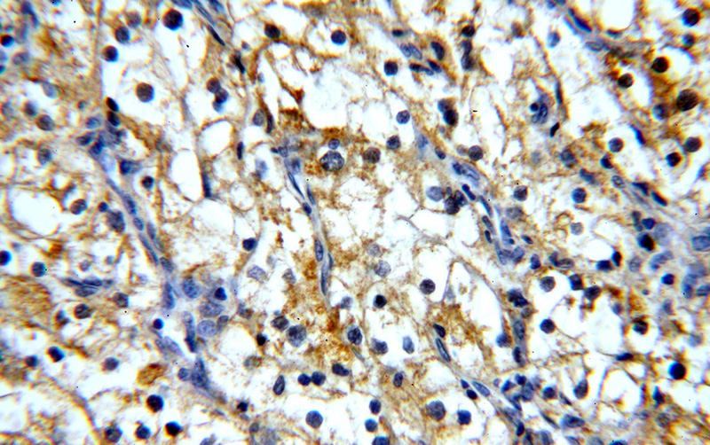 Immunohistochemical of paraffin-embedded human renal cell carcinoma using Catalog No:107427(MME,CD10 antibody) at dilution of 1:100 (under 40x lens)