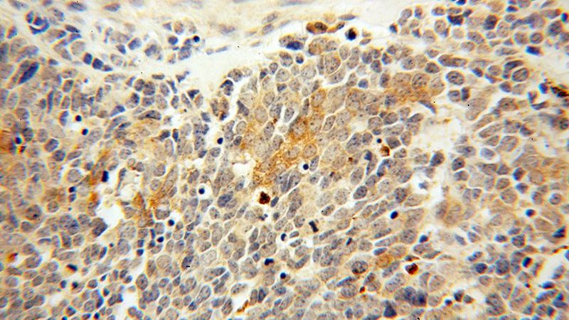 Immunohistochemical of paraffin-embedded human lung cancer using Catalog No:112905(MVD antibody) at dilution of 1:50 (under 40x lens)