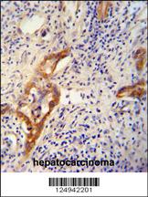 CLPX antibody (C-term) (Cat. #169132) immunohistochemistry analysis in formalin fixed and paraffin embedded human hepatocarcinoma followed by peroxidase conjugation of the secondary antibody and DAB staining.  This data demonstrates the use of the CLPX