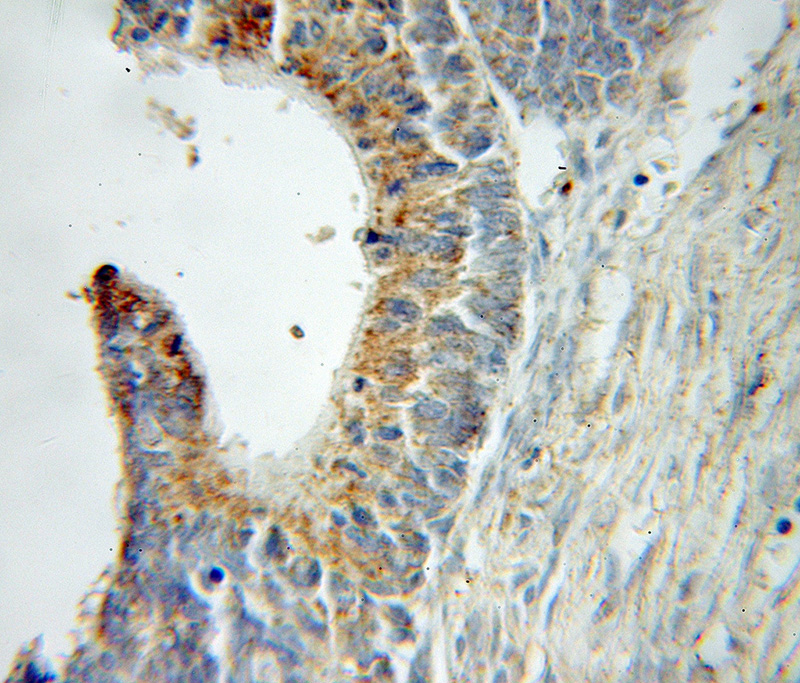 Immunohistochemical of paraffin-embedded human ovary tumor using Catalog No:116127(TIMM23 antibody) at dilution of 1:50 (under 10x lens)