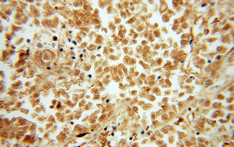 Immunohistochemical of paraffin-embedded human lung cancer using Catalog No:114380(PSMB10 antibody) at dilution of 1:50 (under 40x lens)
