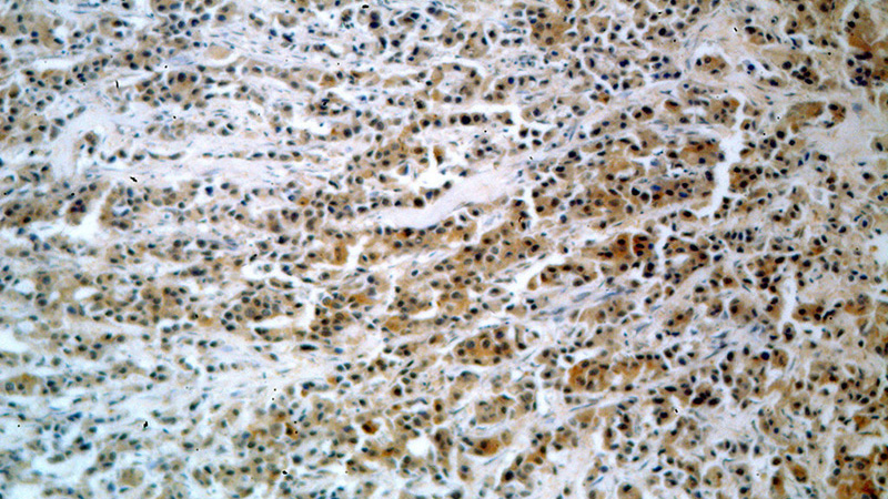 Immunohistochemical of paraffin-embedded human breast cancer using Catalog No:109217(CHD1 antibody) at dilution of 1:100 (under 10x lens)