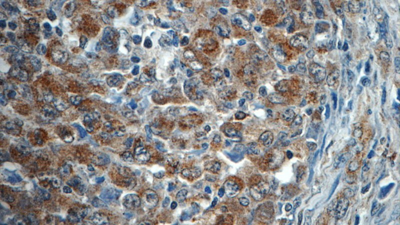 Immunohistochemistry of paraffin-embedded human lymphoma tissue slide using Catalog No:107983(ALK,CD246 Antibody) at dilution of 1:50 (under 40x lens)