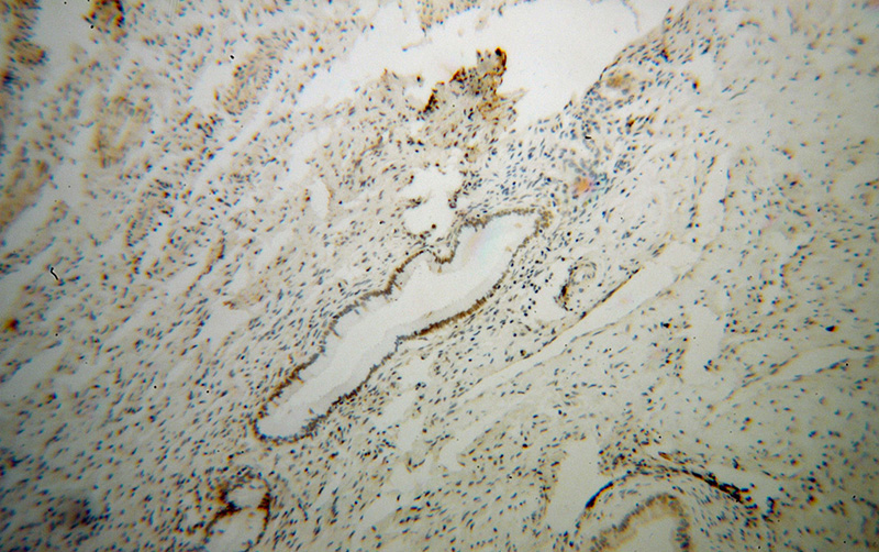 Immunohistochemical of paraffin-embedded human cervical cancer using Catalog No:109220(CHD4 antibody) at dilution of 1:100 (under 10x lens)