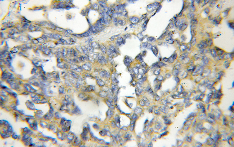 Immunohistochemical of paraffin-embedded human ovary tumor using Catalog No:111455(HPS6 antibody) at dilution of 1:100 (under 10x lens)