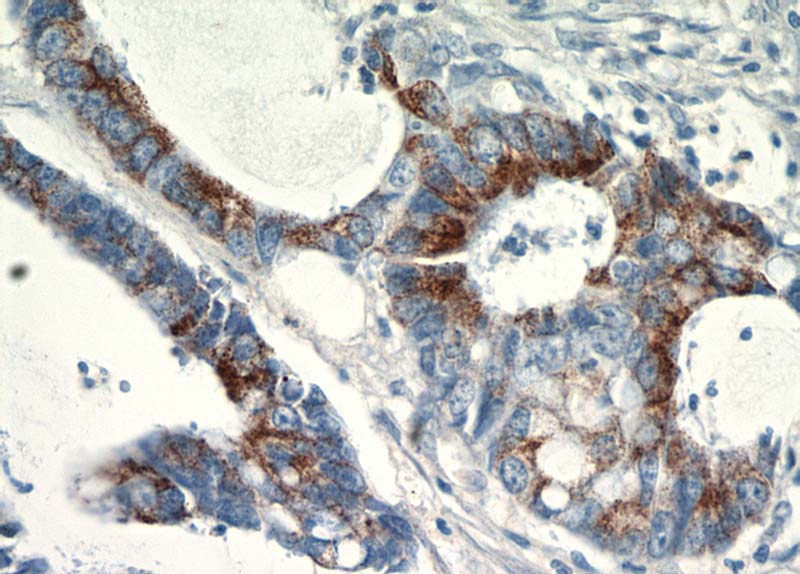 Immunohistochemical of paraffin-embedded human colon cancer using Catalog No:115647(SPRR3 antibody) at dilution of 1:100 (under 40x lens)