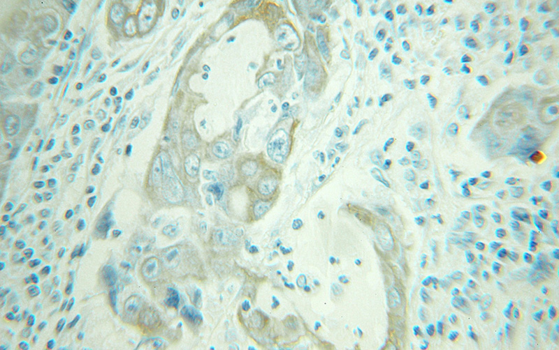 Immunohistochemical of paraffin-embedded human lung cancer using Catalog No:115711(STK16 antibody) at dilution of 1:100 (under 25x lens)