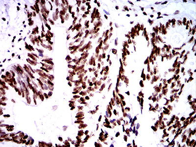 Fig6: Immunohistochemical analysis of paraffin-embedded human rectum cancer tissue using anti-ZFP91 antibody. Counter stained with hematoxylin.