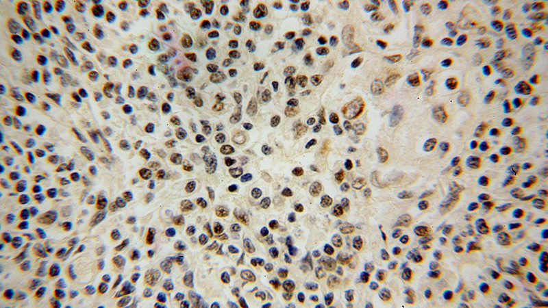 Immunohistochemical of paraffin-embedded human lymphoma using Catalog No:111648(IKZF2 antibody) at dilution of 1:100 (under 40x lens)